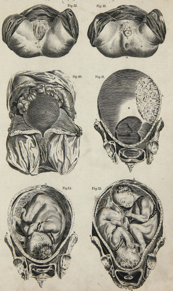 Hall, William Henry - Encyclopedia - "Anatomie" - Geburtshilfe